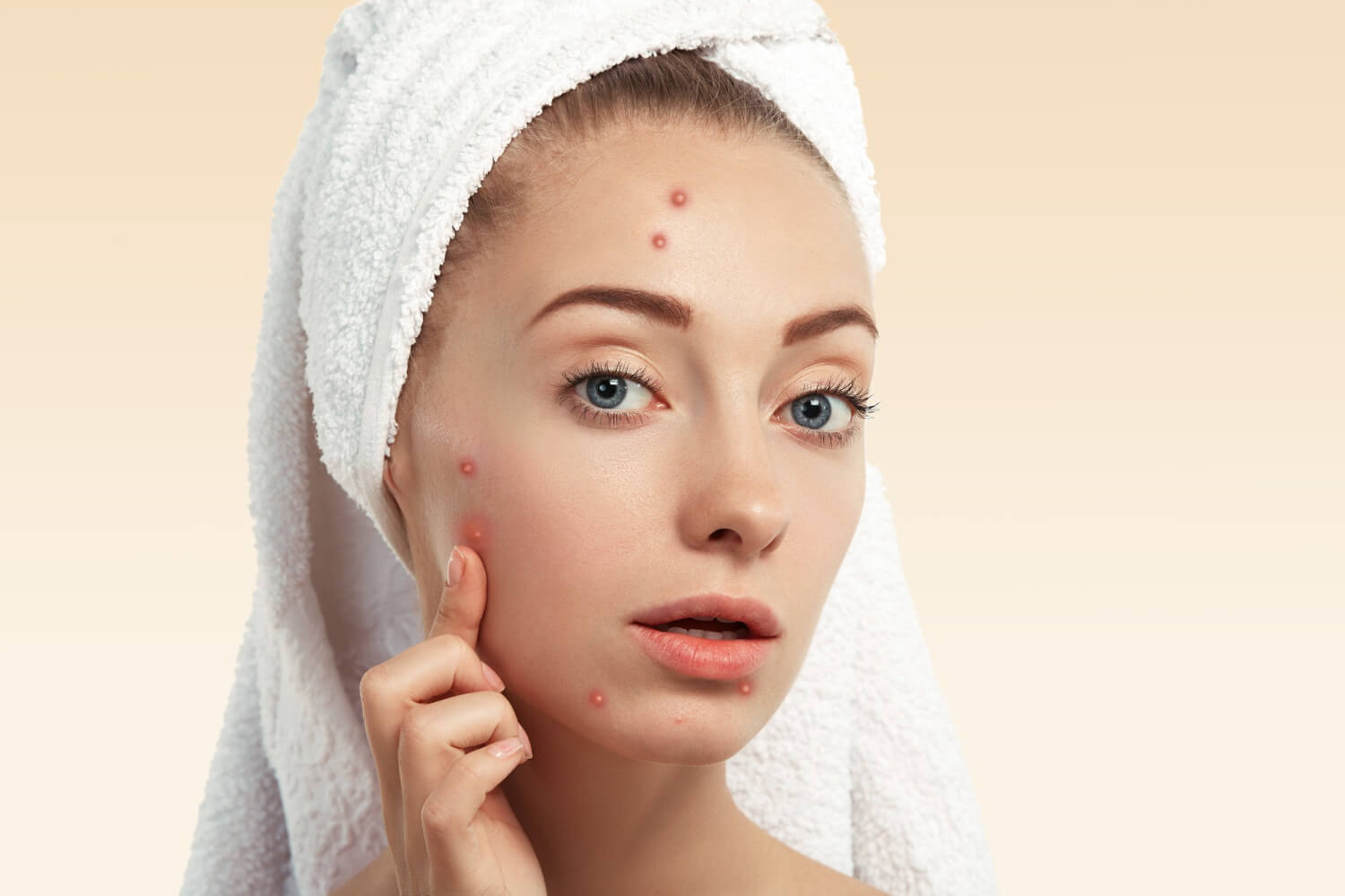 Acne e Espinha – Tratamentos, Causas e Prevenção