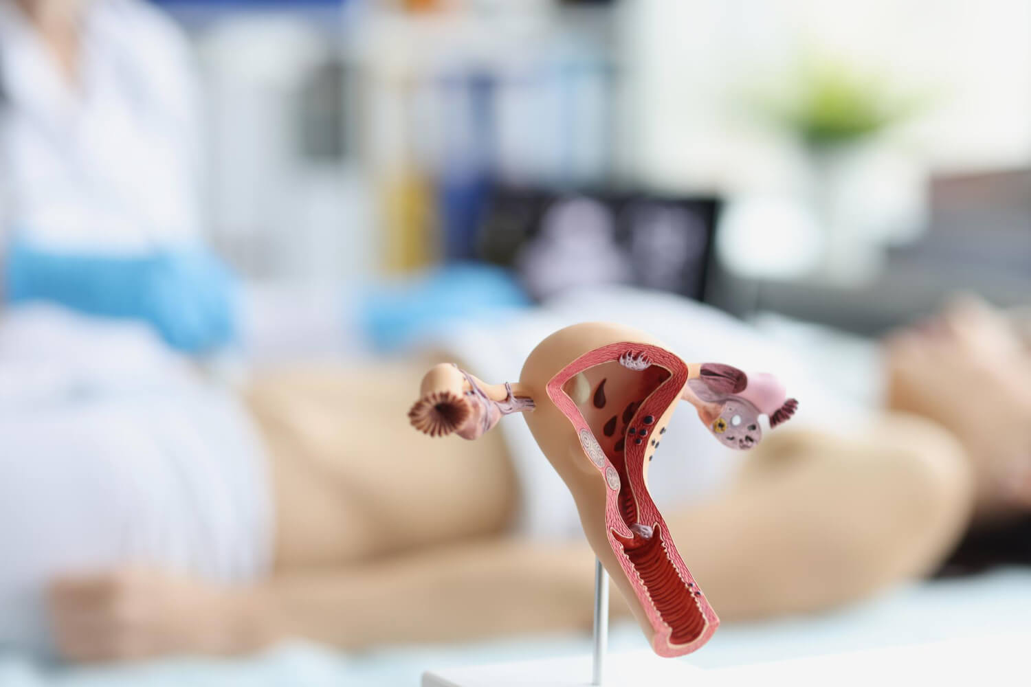 Histerectomia: Indicações, tipos e recuperação
